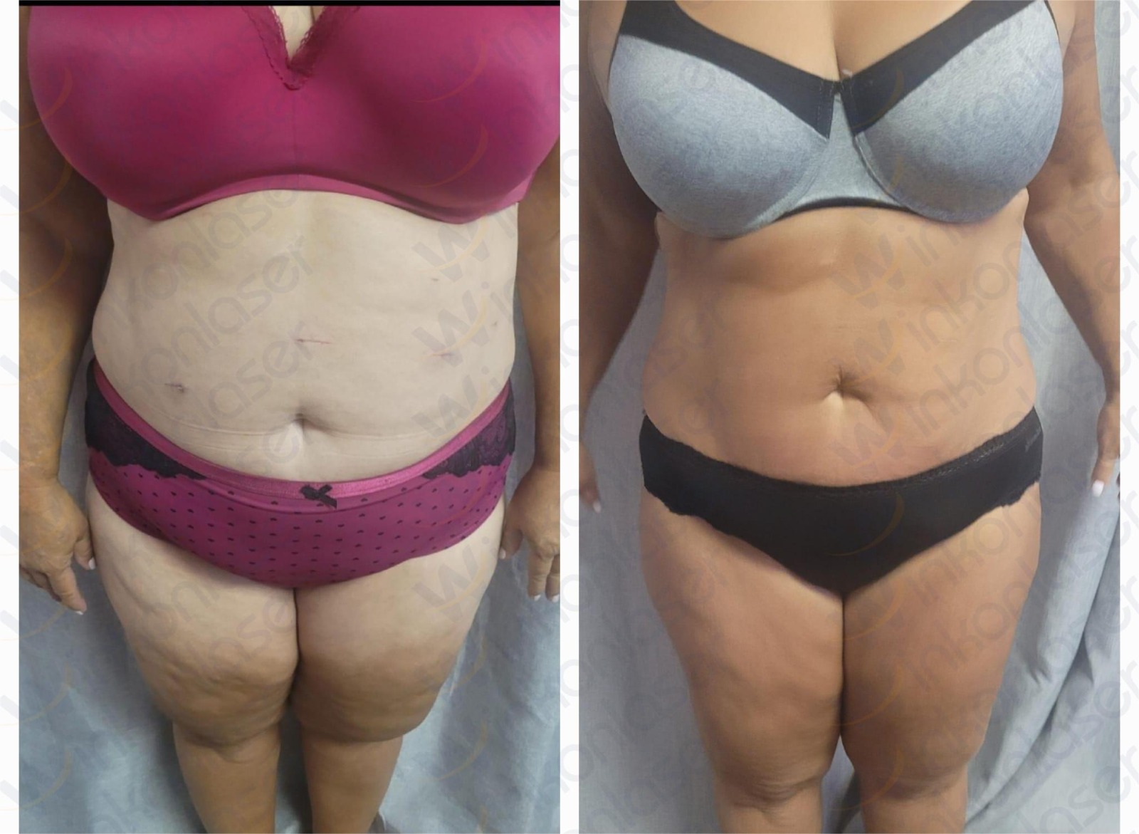 Renasculpt result 3